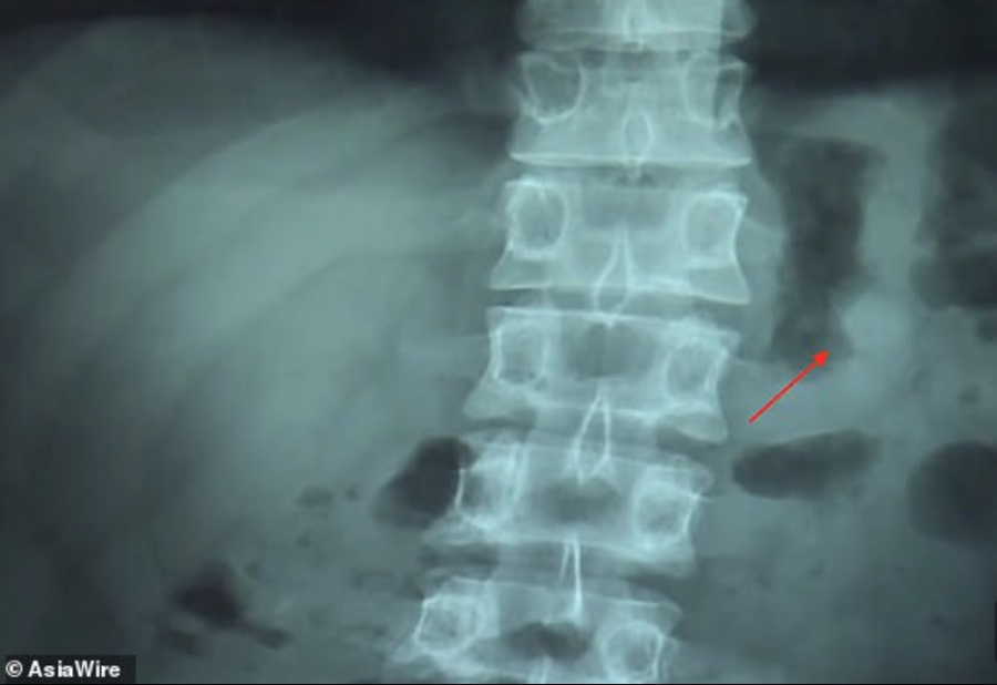 Inghiotte un AirPods e dopo un giorno lo espelle, funziona ancora