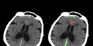L’intelligenza artificiale individua le emorragie cerebrali