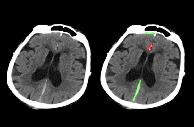 L’intelligenza artificiale individua le emorragie cerebrali