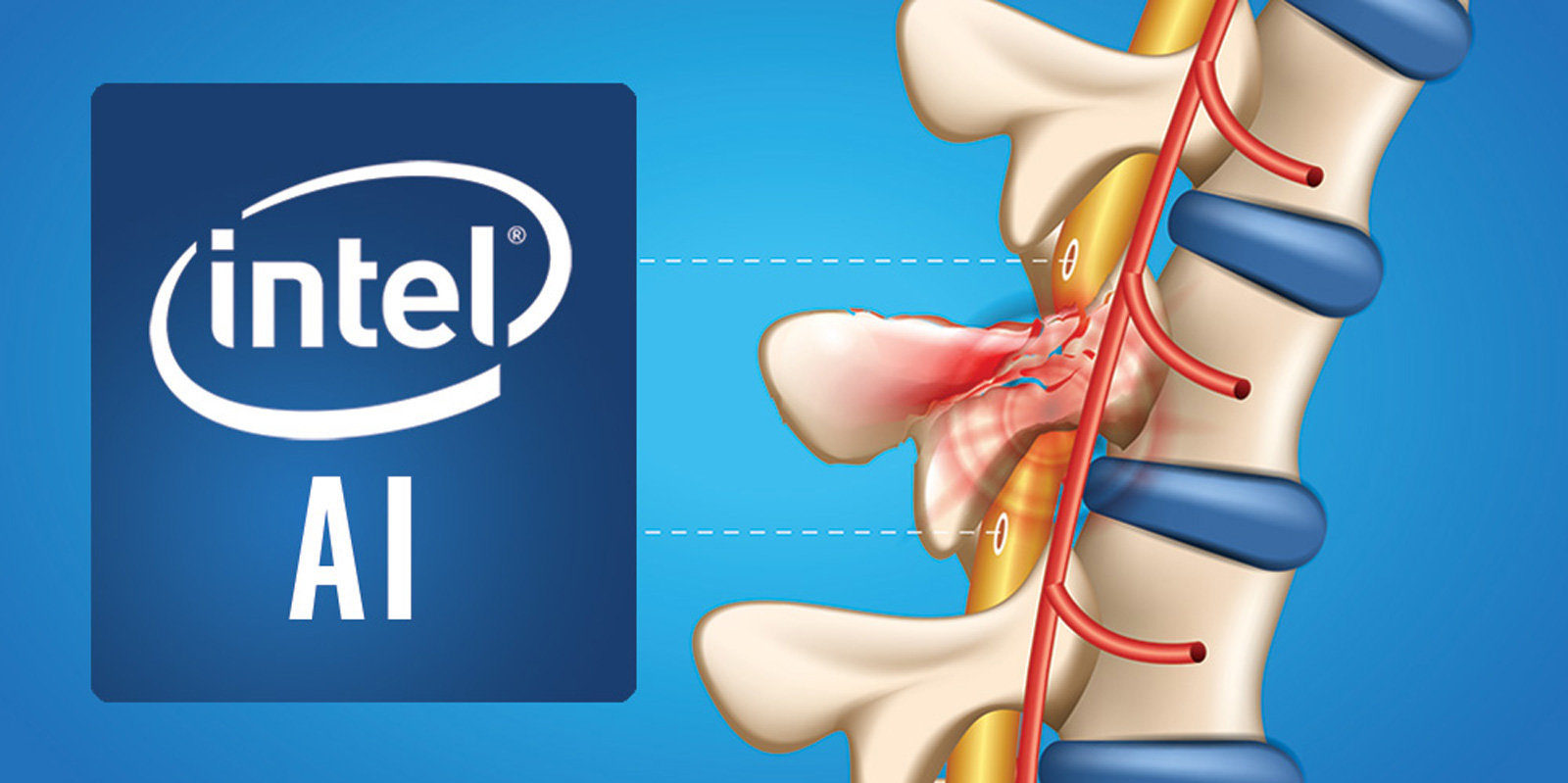 Intel vuole usare l’Intelligenza Artificiale per riparare le lesioni al midollo spinale