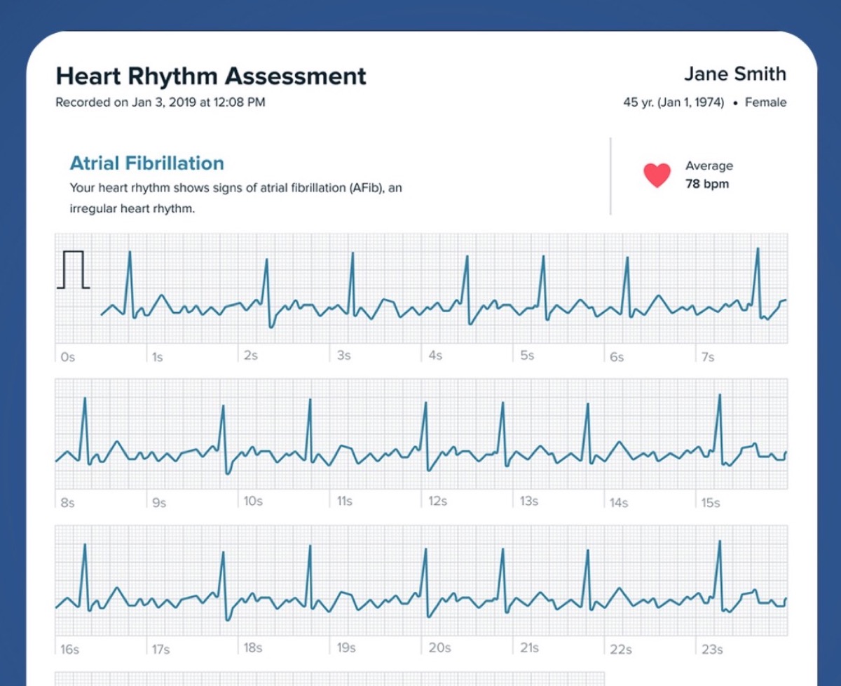 Ora l'ECG di Fitbit Sense funziona anche in Italia