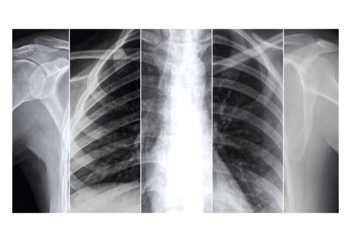 Un modello di intelligenza artificiale legge le radiografie e fa prognosi nei pazienti affetti da COVID-19