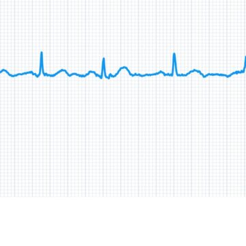 Recensione Withings ScanWatch, il miglior ibrido in campo clinico